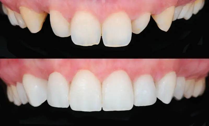 Hollywood Smile ganz ohne Photoshop: Mit Hilfe von Veneers und einem erfahrenen Zahnarzt ist das Hollywood-Lachen schnell Realität. 