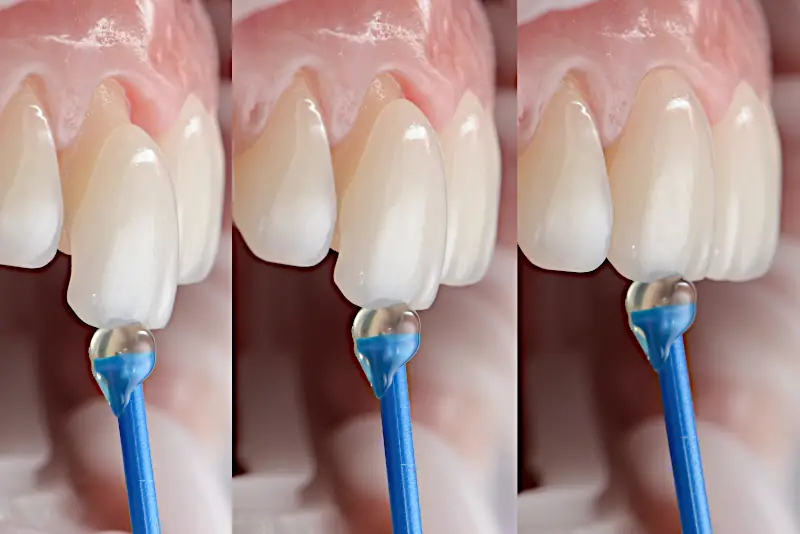 Hollywood Smile ganz ohne Photoshop:  Ein Veneer wird mit Hilfe eines speziellen Klebstoffes auf die Zähne gesetzt.